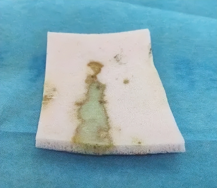 慢性创面患者的敷料运用及选择,创面换药敷料的选择