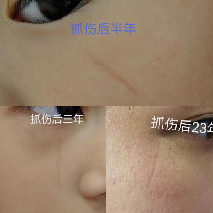 点阵激光后的伤口要几天愈合,伤口做点阵激光治疗