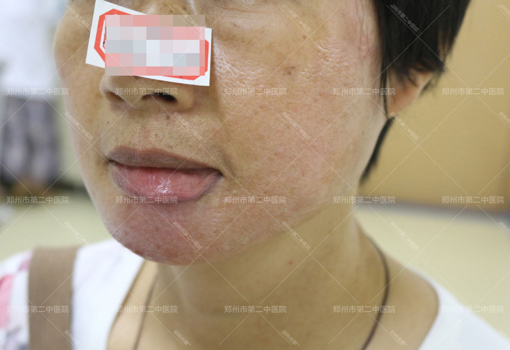 郑州脸部疤痕修复正规治疗医院,郑州第二中医院疤痕收费价格