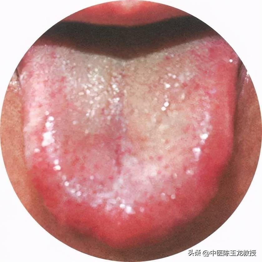 感染甲流喝哪几款中药,三招看你是否感染甲流