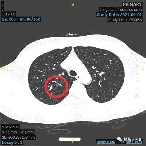 炎症引起的肺实性结节生长速度,肺部结节影像学读片讲解视频