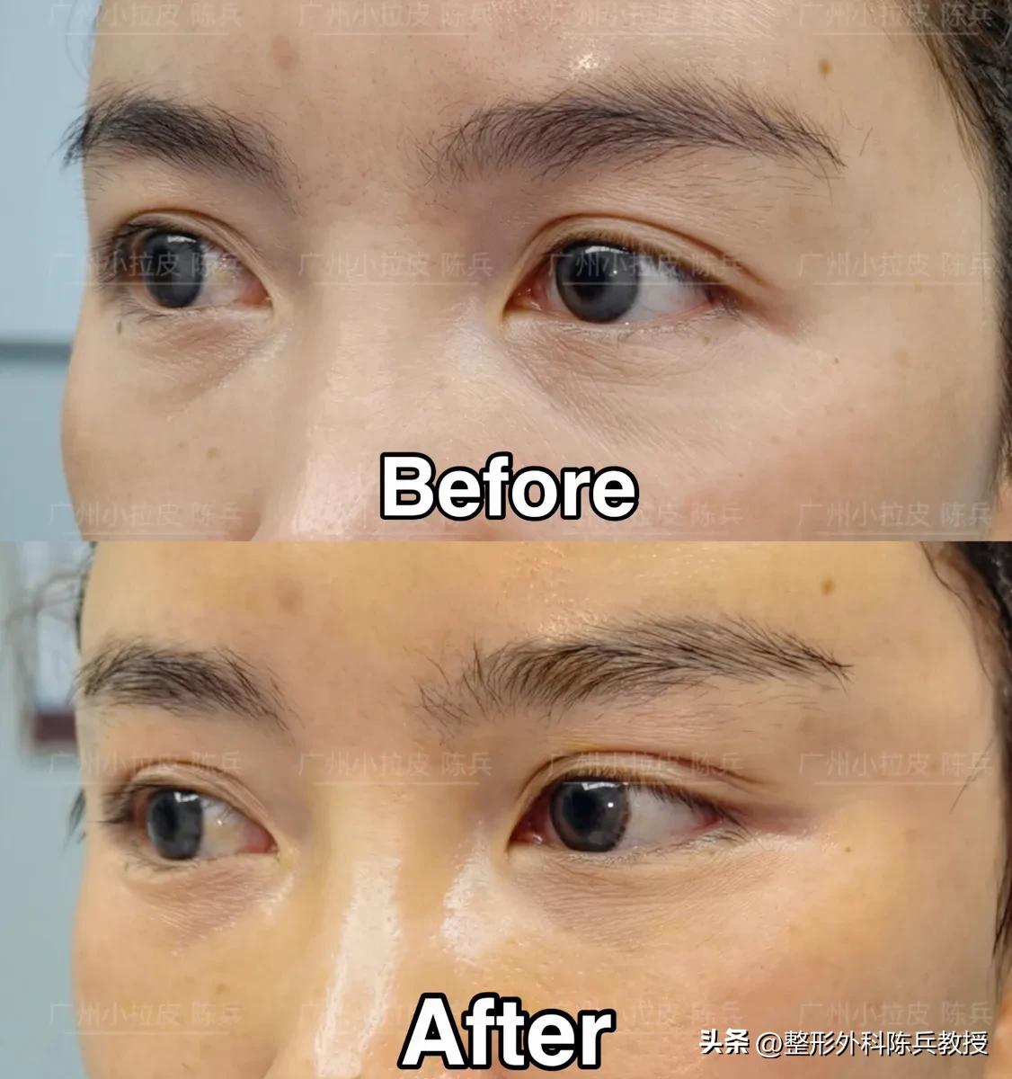 抗衰大拉皮,拉皮作为面部抗衰项目要注意哪些