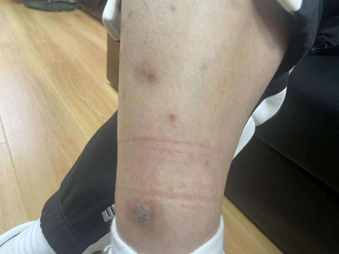 湖北公安：被毒打、电击、转卖三次梦碎缅甸大冶男子获救后亲诉惨痛经历