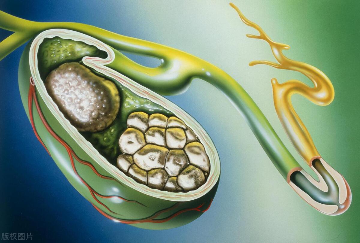 胡博士治疗胆囊息肉——息肉彩超怎么看？