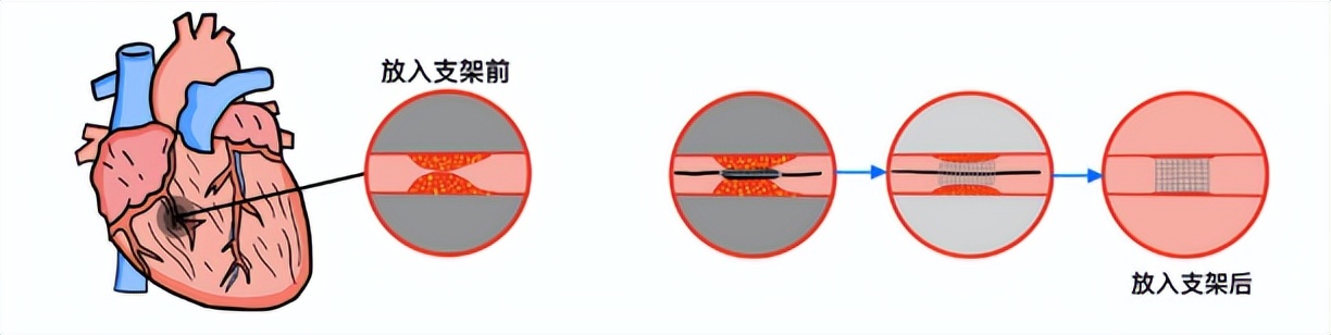 心肌梗死最佳急救时间,心肌梗死急救的穴位