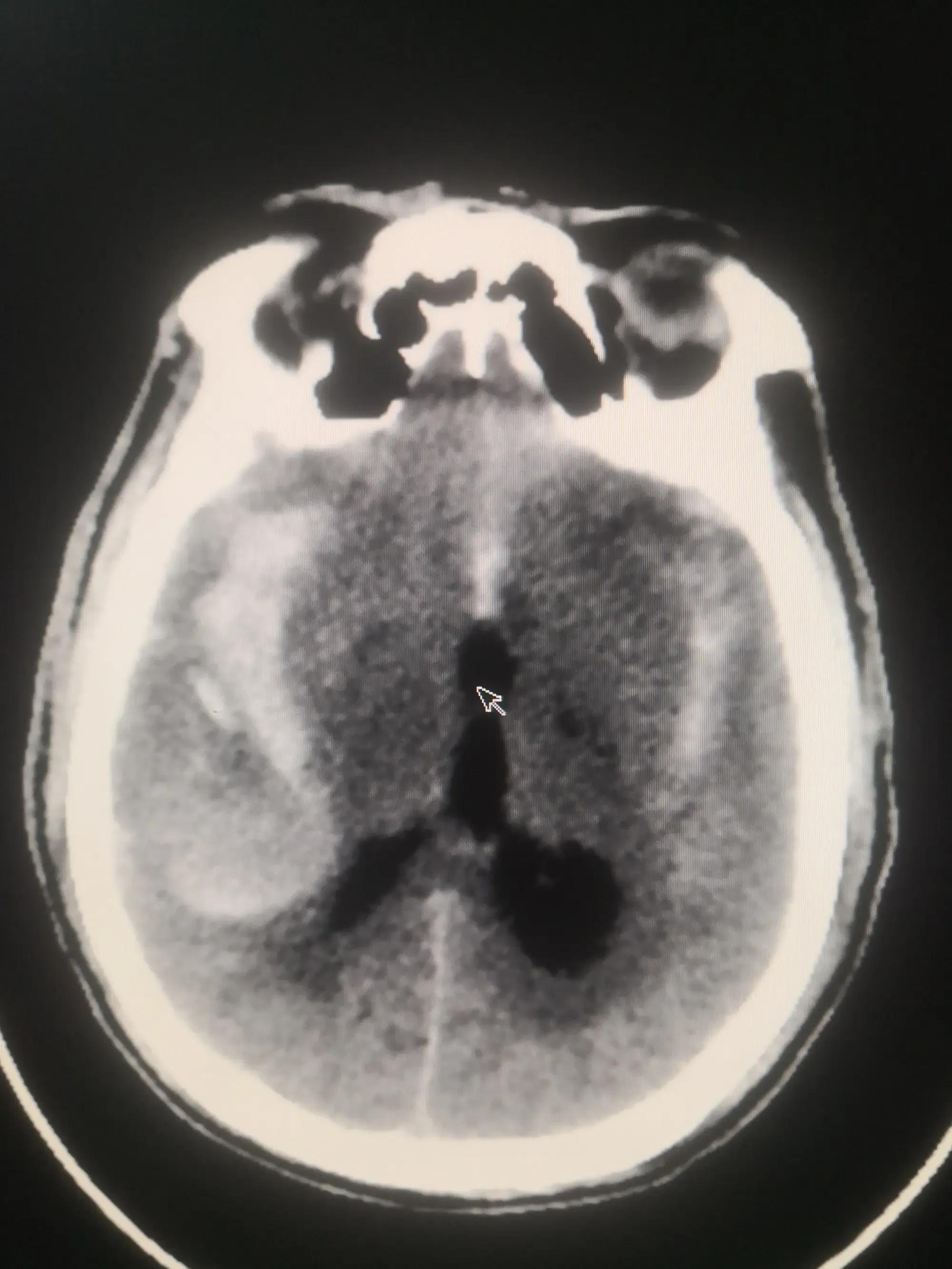 不明原因的眼皮耷拉下垂,可能是这个可怕的病