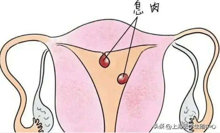 试管不能着床有必要做宫腔镜吗,胚胎移植着床失败后要做宫腔镜吗
