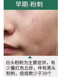 青春痘变疮了要怎么治,治脓包型青春痘偏方