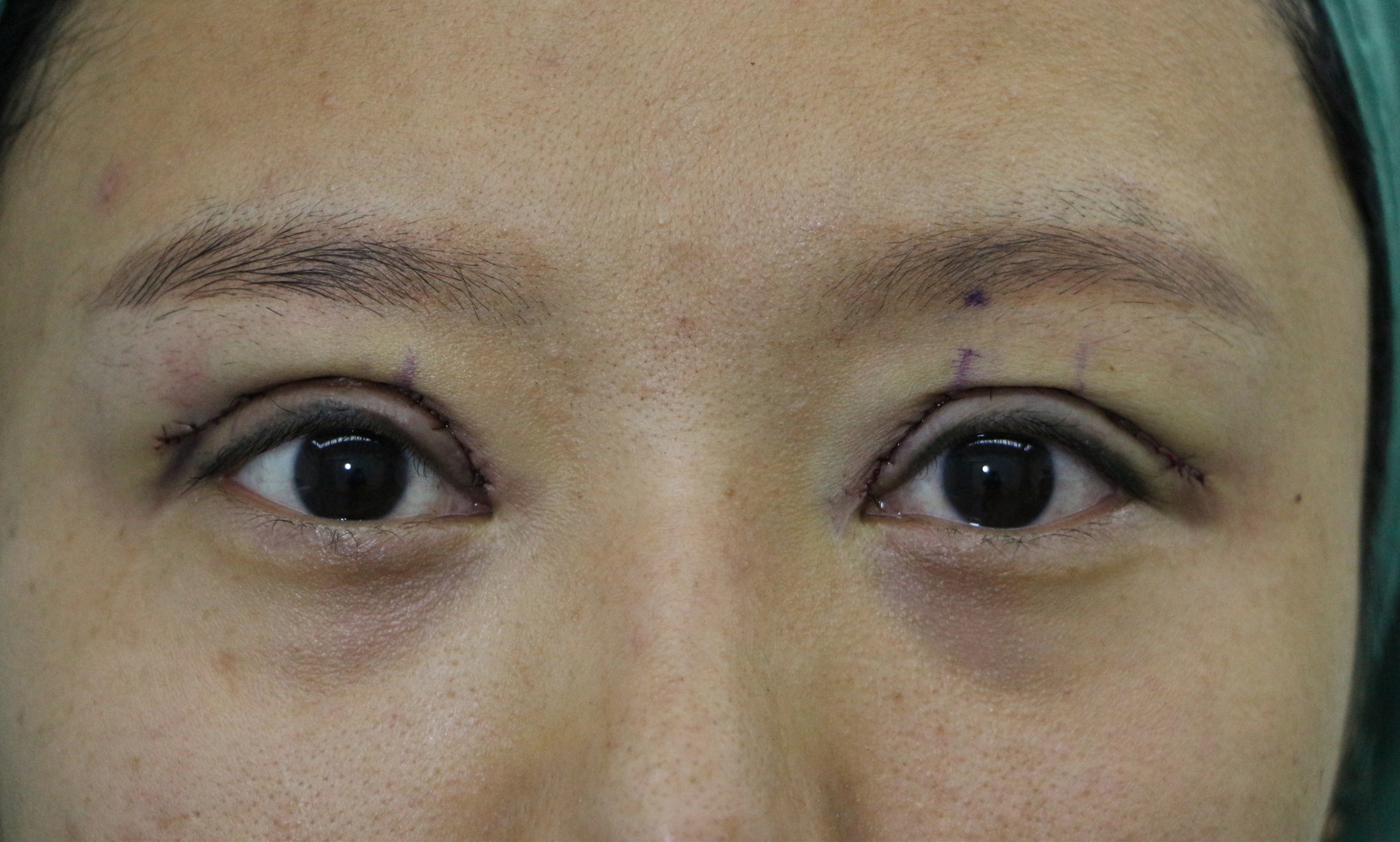 双眼皮修复新乡,姑娘眼部整形后双眼皮变三眼皮