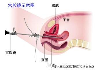 高危hpv1652自己转阴的概率是多少,hpv高危82型感染了三年了还未转阴