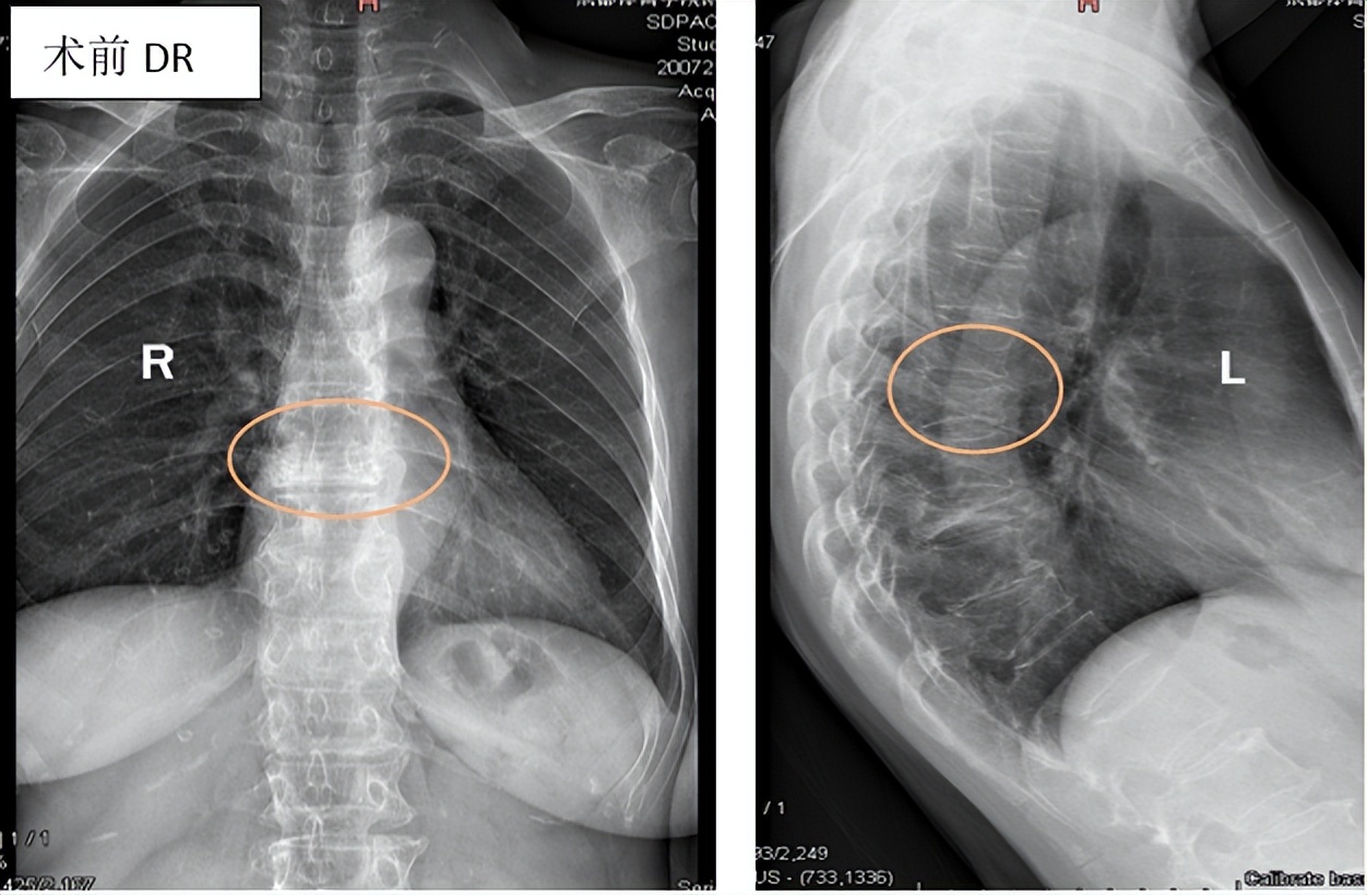 胸腰椎压缩性骨折特色治疗方法,老年人胸腰椎骨折怎么治疗