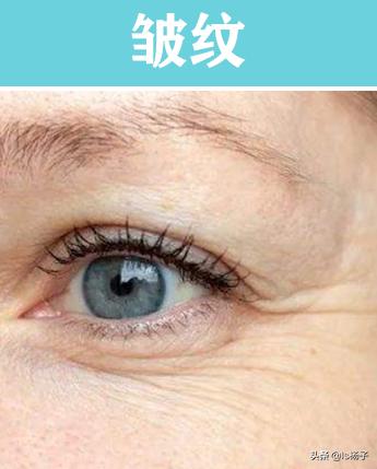 干纹细纹最佳治疗方法,干纹皱纹怎么去除小方法