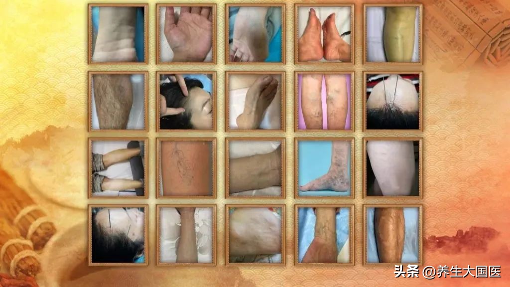 手脚血管突然明显凸起,心脏血管三高怎么预防