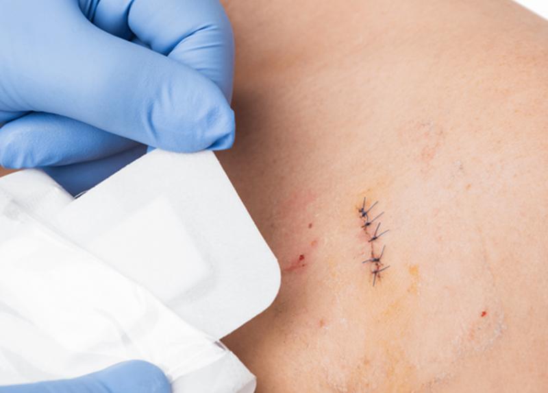 不小心刀划开伤口怎么处理,开放性伤口的正确处理方法