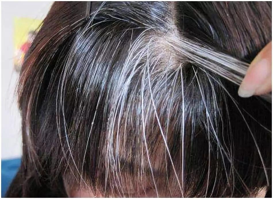 人体缺少哪种维生素会白头发,人体缺什么维生素会长白发