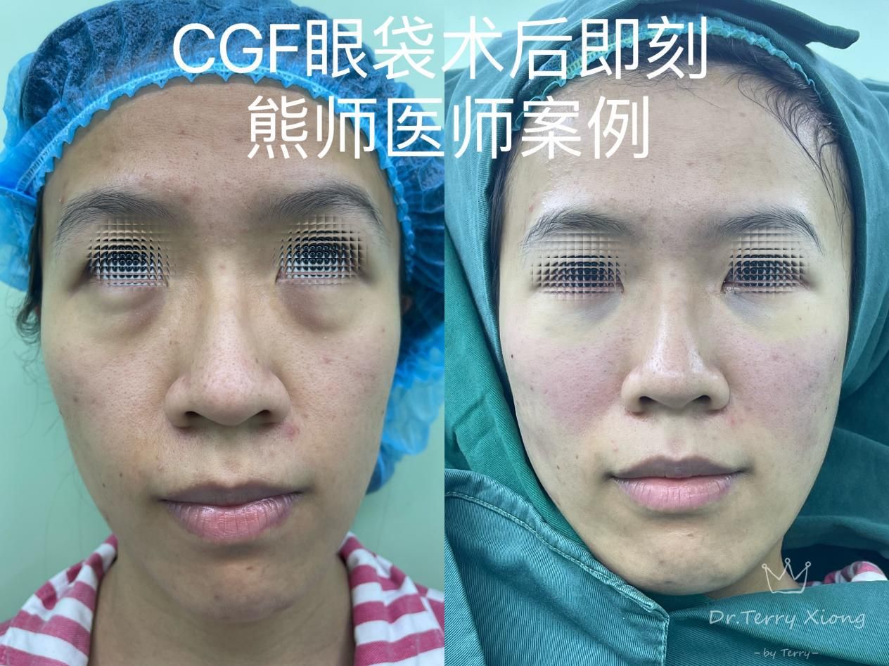 去掉眼袋的土办法是什么,眼袋除了手术还有什么办法