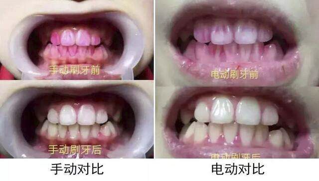 电动牙刷使用方法和普通牙刷一样,电动牙刷怎么使用才是正确的