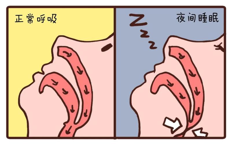 打呼真的能治吗,怎么有效治疗打呼