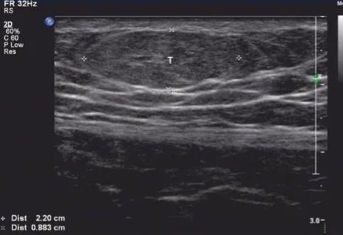 身体上长了脂肪瘤怎么办？需要处理吗？