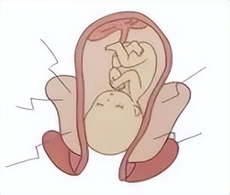 子宫收缩剧烈会羊水破裂吗,子宫小会导致羊水早破吗