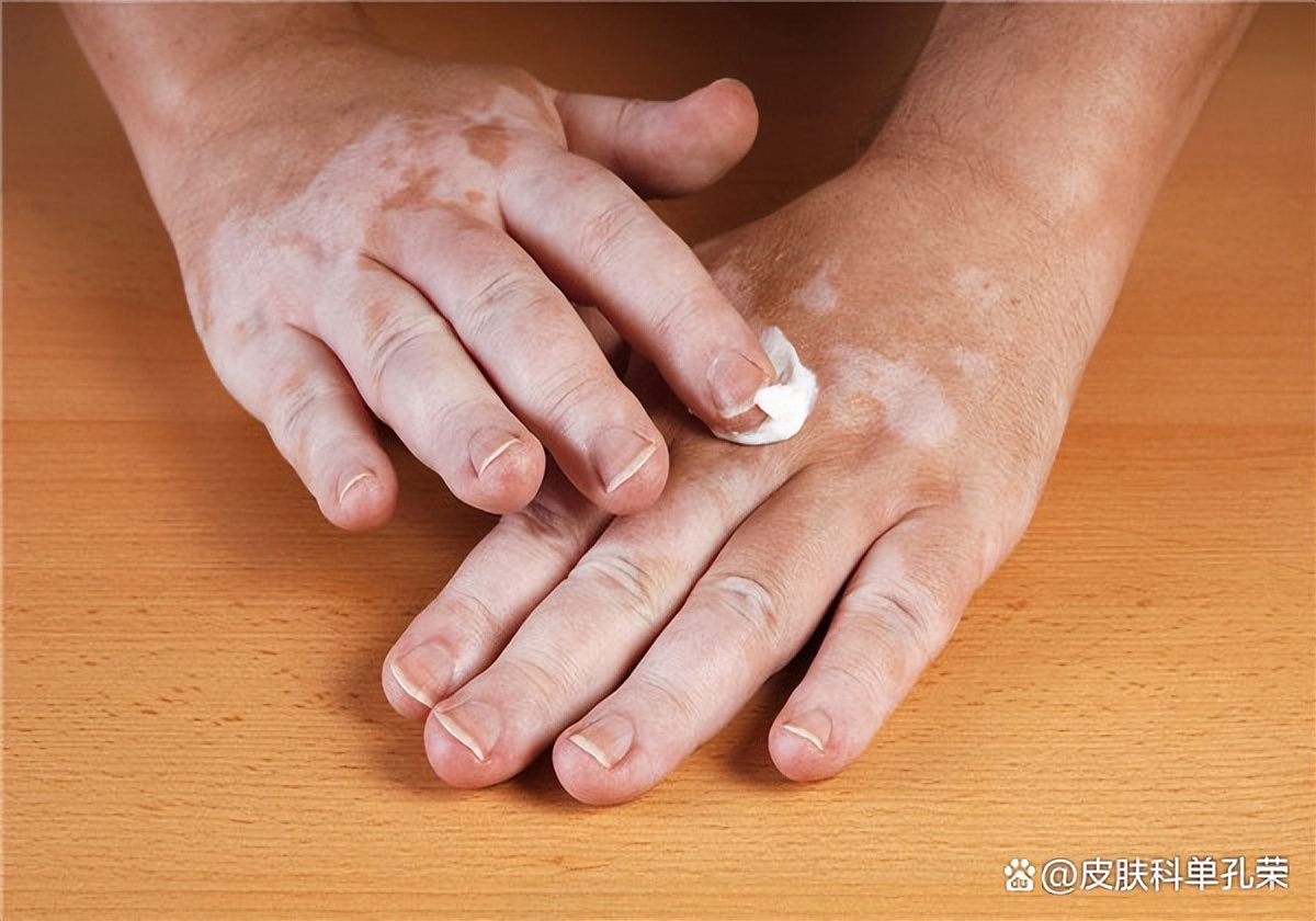 白斑发红发痒是什么原因,白斑痒了是意味着白斑发展了吗