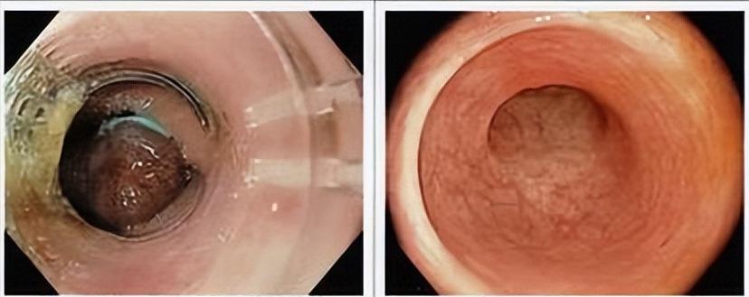 结直肠癌一般发病年龄,结直肠癌的诱因及病因