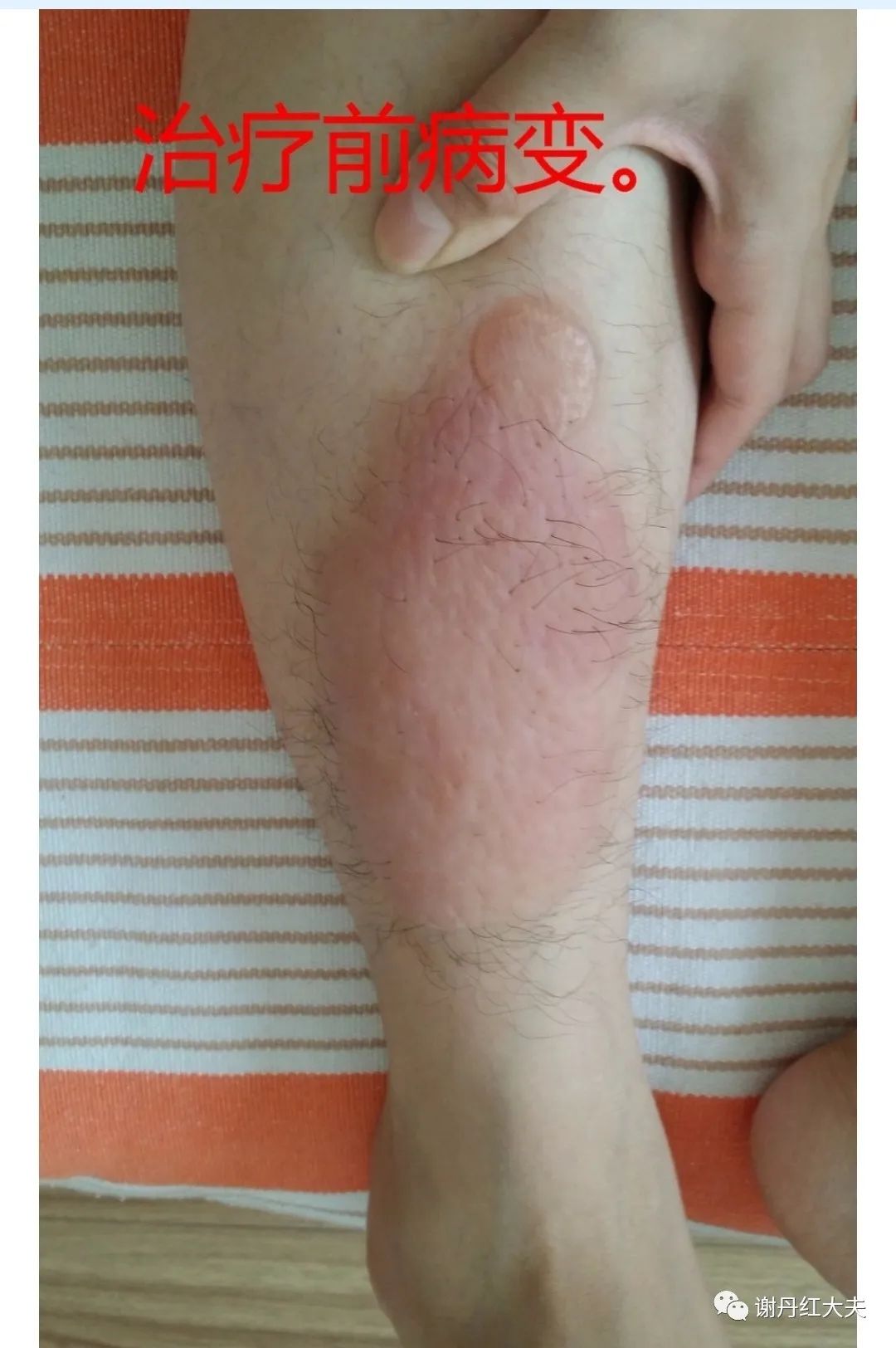 胫前黏液性水肿见于哪些病,胫前黏液性水肿为凹陷性水肿吗