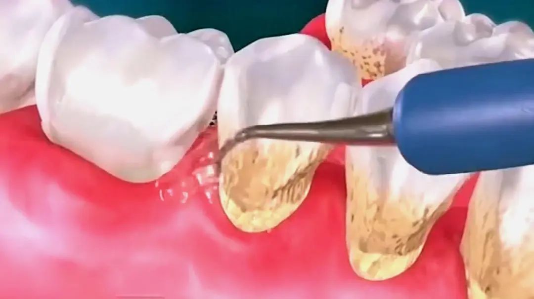 怎样让萎缩的牙龈重新长出来,牙龈萎缩还能长回去吗