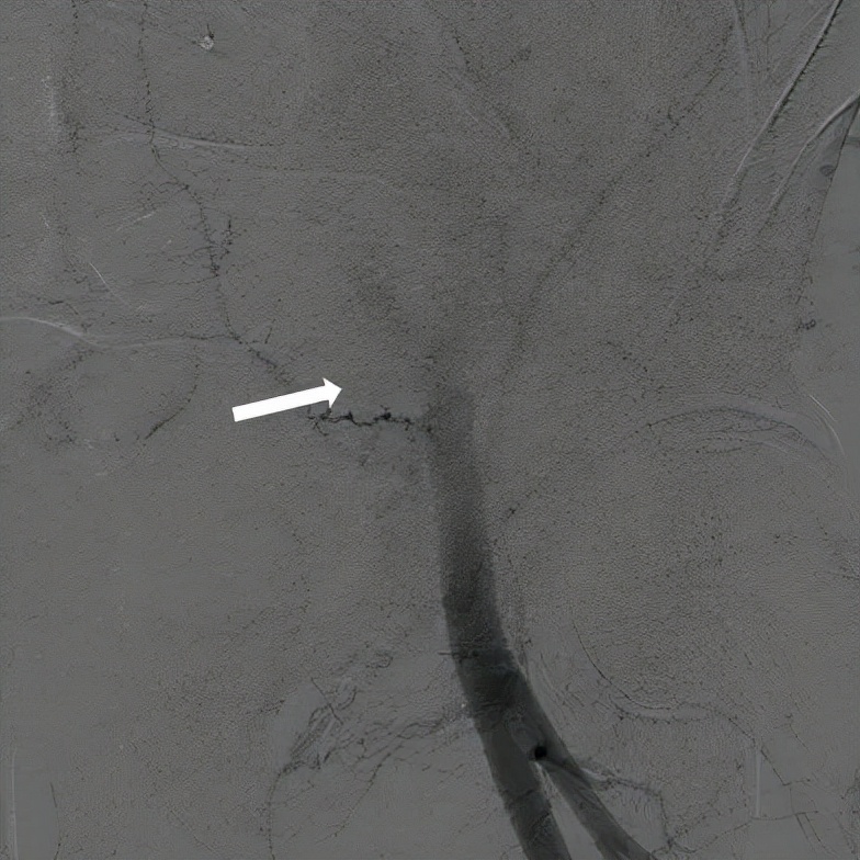 病例回顾与分享,腹膜后血肿介入治疗