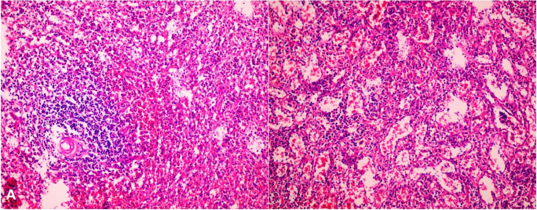 肝硬化失代偿期脾栓塞手术,肝硬化脾脏切除术