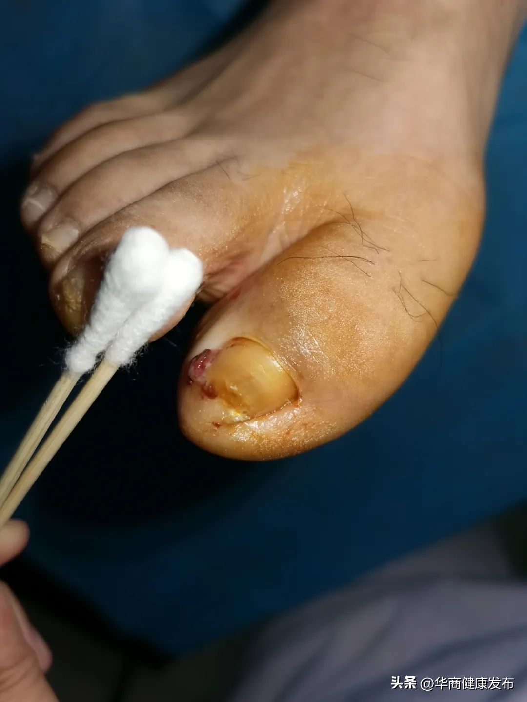 甲沟炎皮肤护理,为什么那么容易得甲沟炎