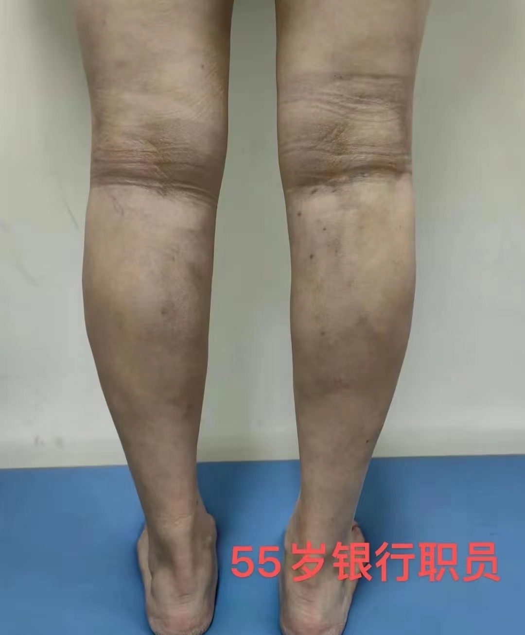 杨医生静脉曲张小视频,济南显微外科医院静脉曲张