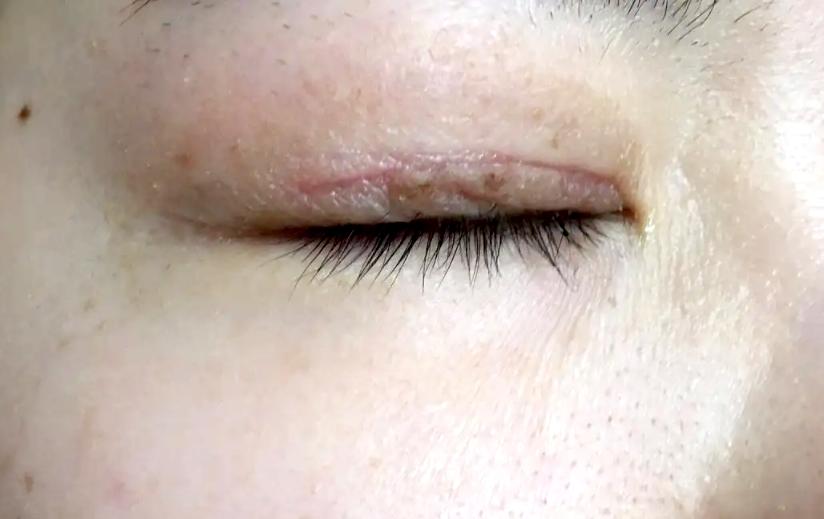 祛疤后疤痕增生怎么办,术后疤痕增生可以不使用祛疤膏吗