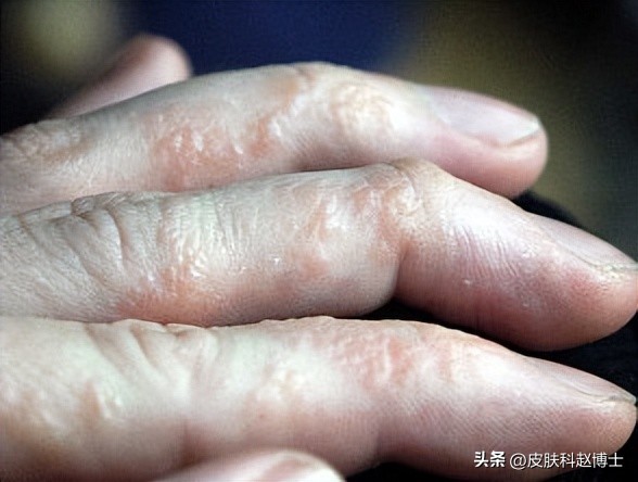 手部角化性湿疹无法痊愈,儿童手部湿疹用什么药膏