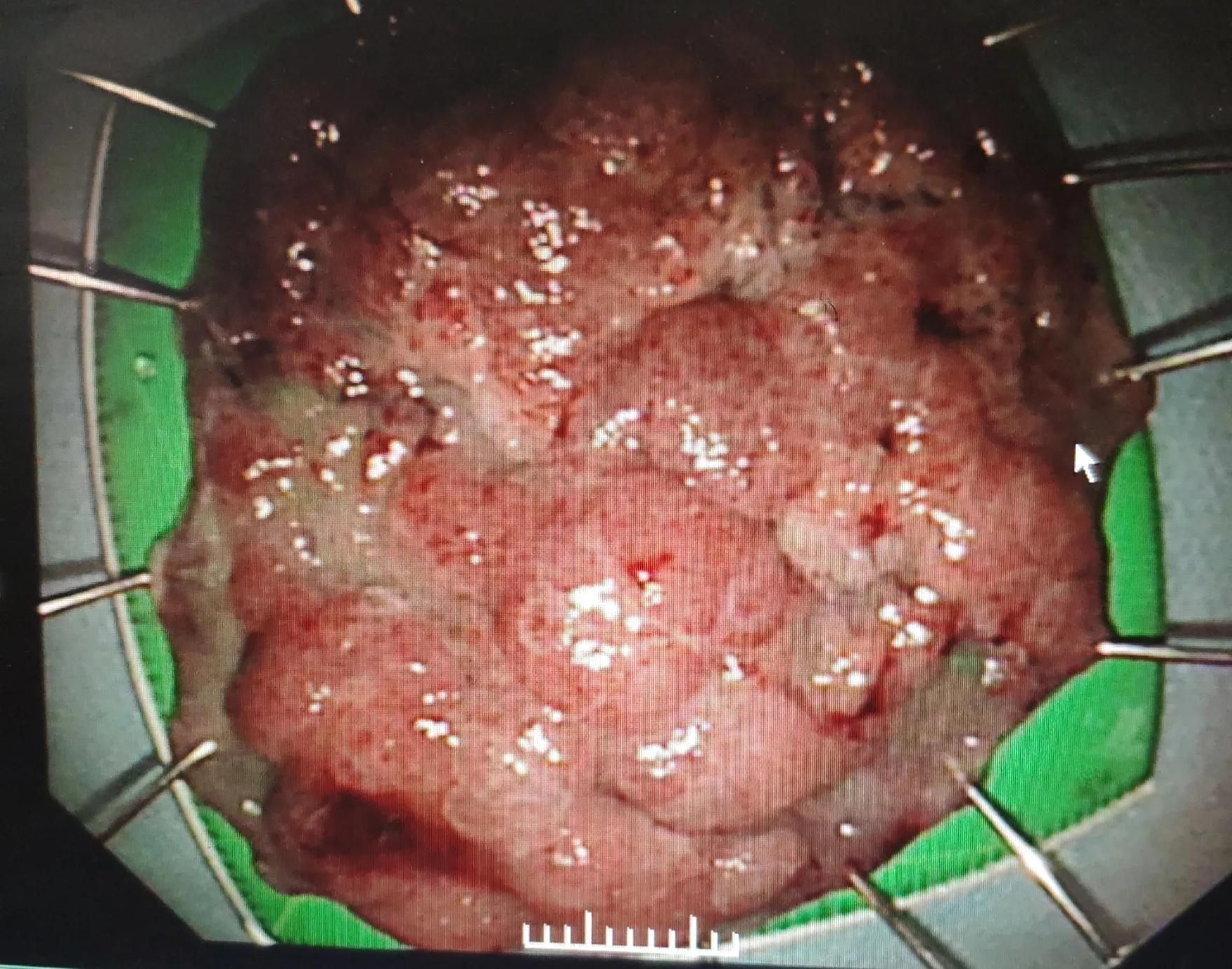 esd手术后续身体感觉,esd手术可靠吗