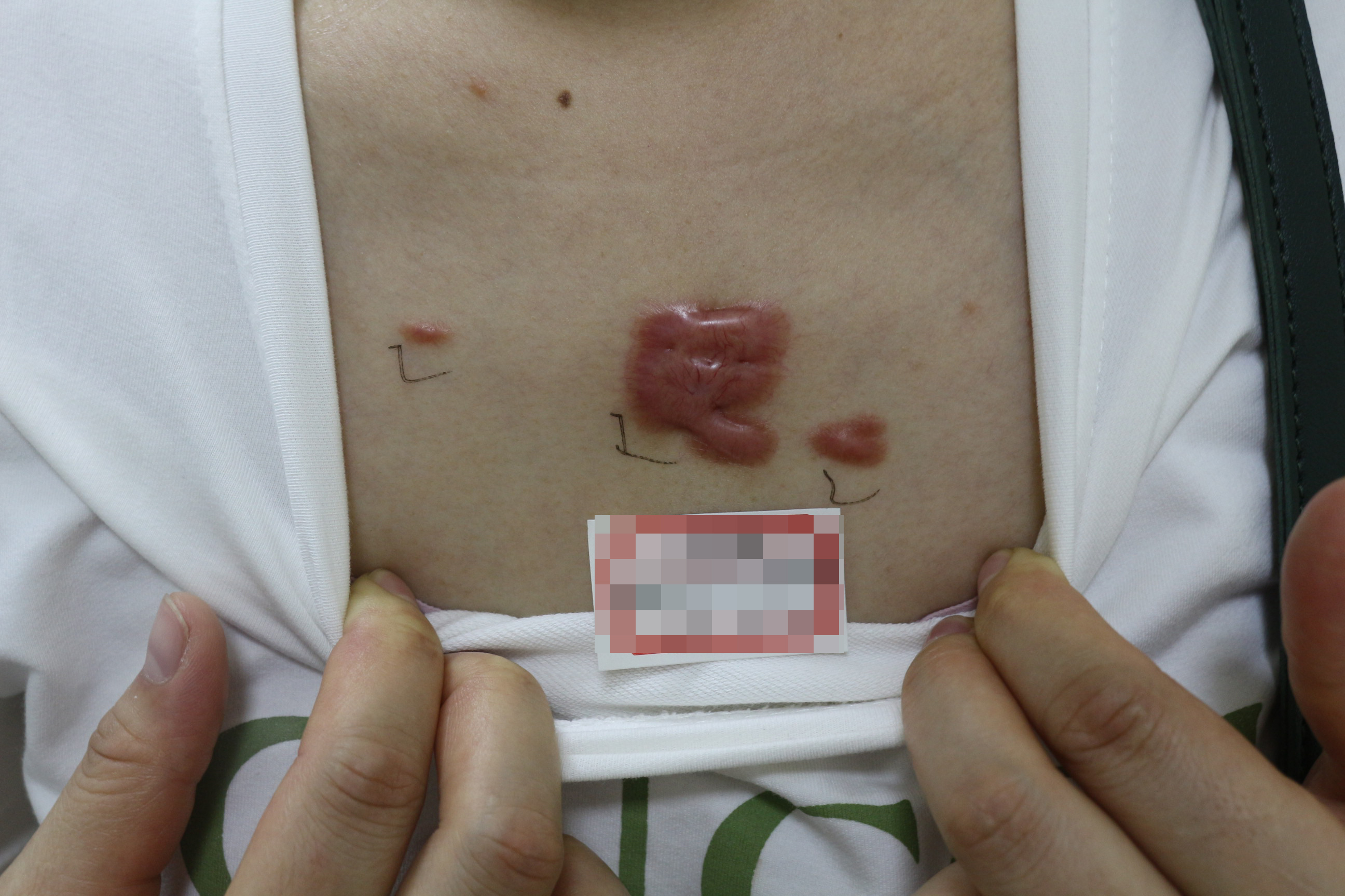 郑州胸前疤痕疙瘩修复医院,郑州第二中医院治疤痕疙瘩靠谱吗