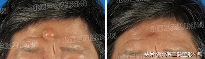 额头上长了个硬疙瘩很疼怎么办,额头上长了一个硬疙瘩是怎么回事