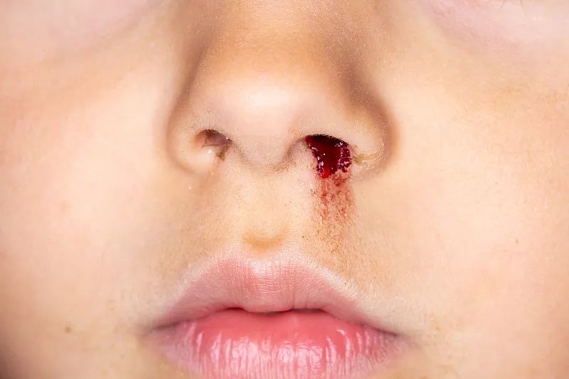 孩子流鼻血怎么快速止血,流鼻血别仰头一招让你快速止血