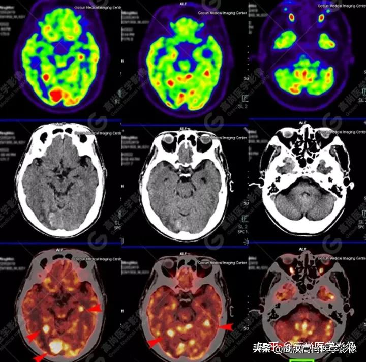 10毫米的肺结节恶性死亡率有多大,1厘米多的肺结节良性可能性多大