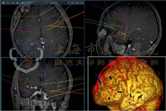 药物无法控制的癫痫,癫痫药物控制几年不发作算痊愈