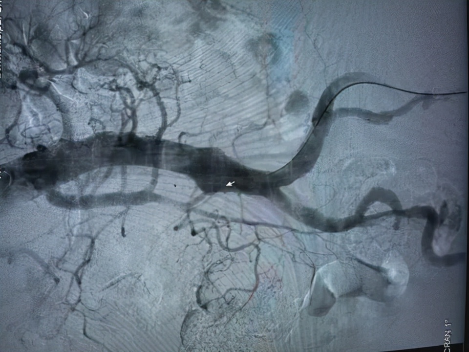 大脑中动脉动脉瘤介入栓塞手术,大脑前动脉夹层手术