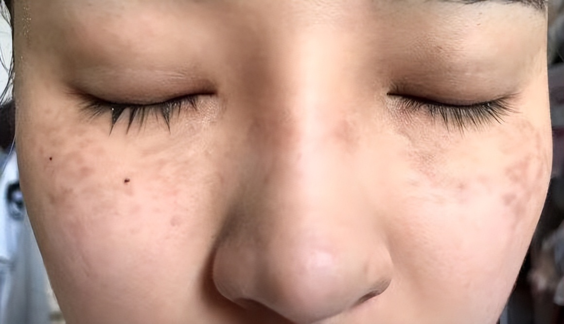 生孩子斑变多了会消失吗,生宝宝皮肤为什么长斑