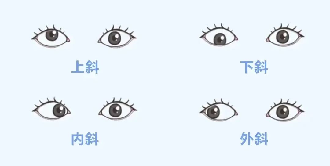 为什么现在小孩斜视的那么多,孩子斜视怎么调整过来