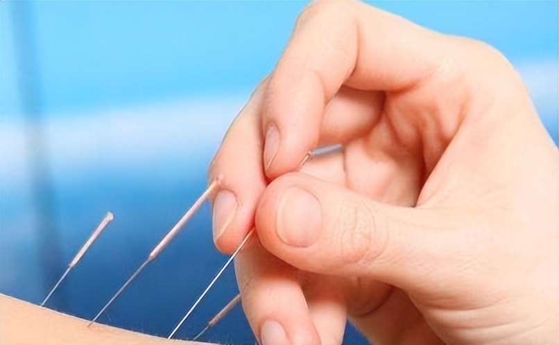 刺络拔罐联合常规针刺治疗神经根型颈椎病如何治疗?疗效如何?