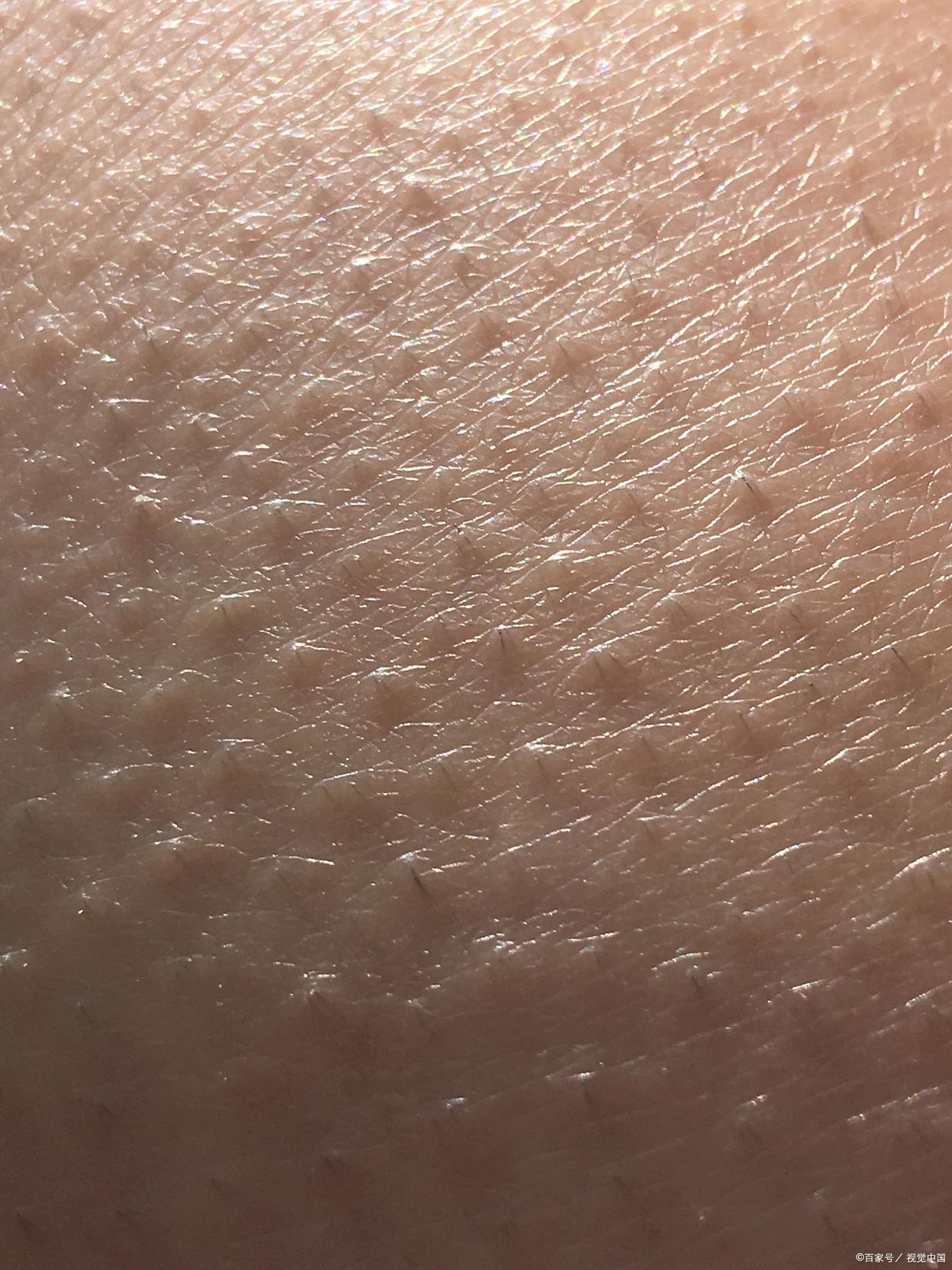 自己怎么改善毛孔粗大缩小毛孔,有痘痘毛孔粗大怎样缩小毛孔