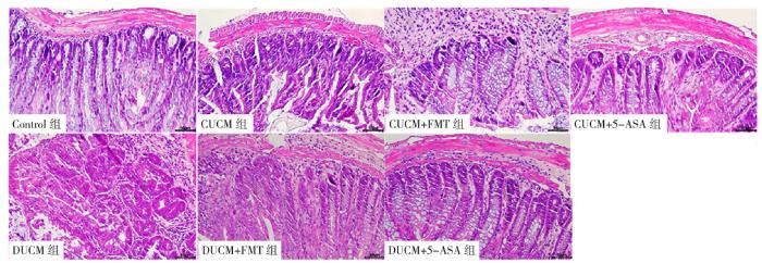 粪菌移植对溃疡性结肠炎的保护,粪菌移植治疗溃疡性结肠炎靠谱吗