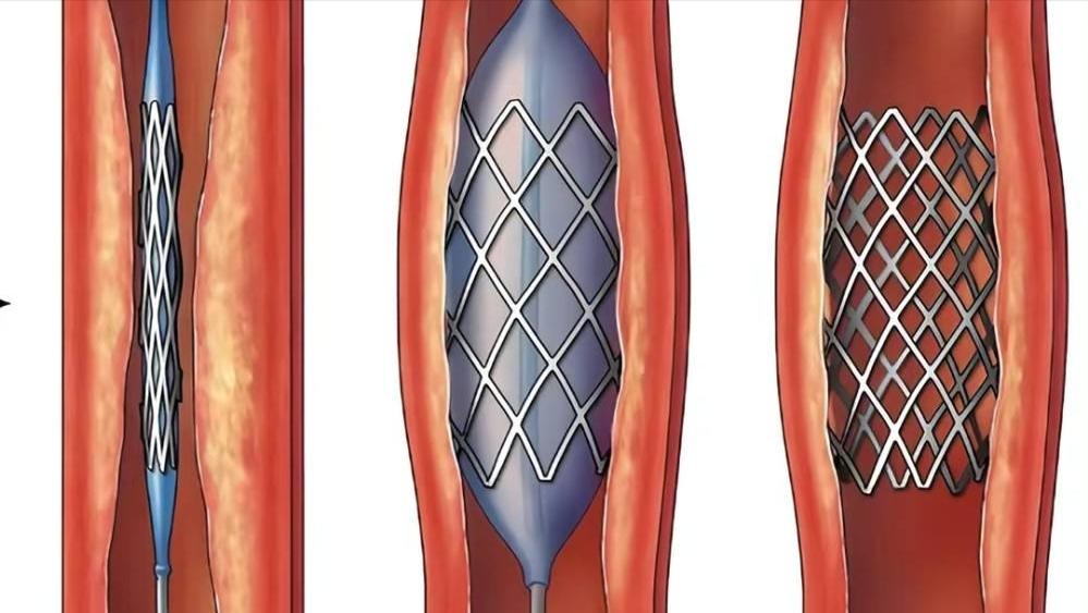 心脏支架手术做了还会堵,还有必要做吗?做与不做取决于这一点