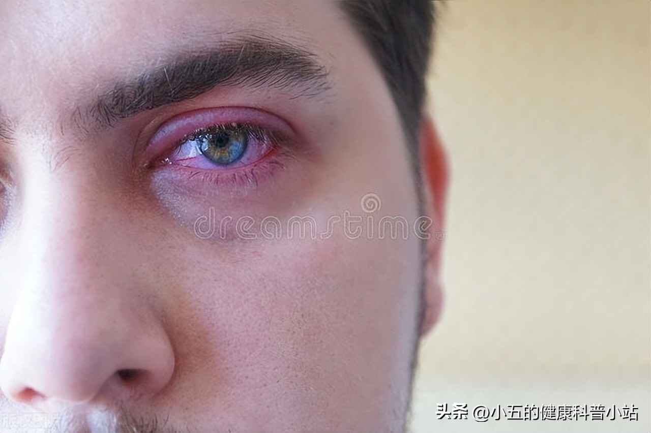 重症肌无力上眼睑下垂怎么描述,重症肌无力眼睑下垂严重程度分级