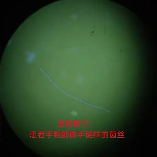 湿疹困扰,湿疹合并真菌感染脚气