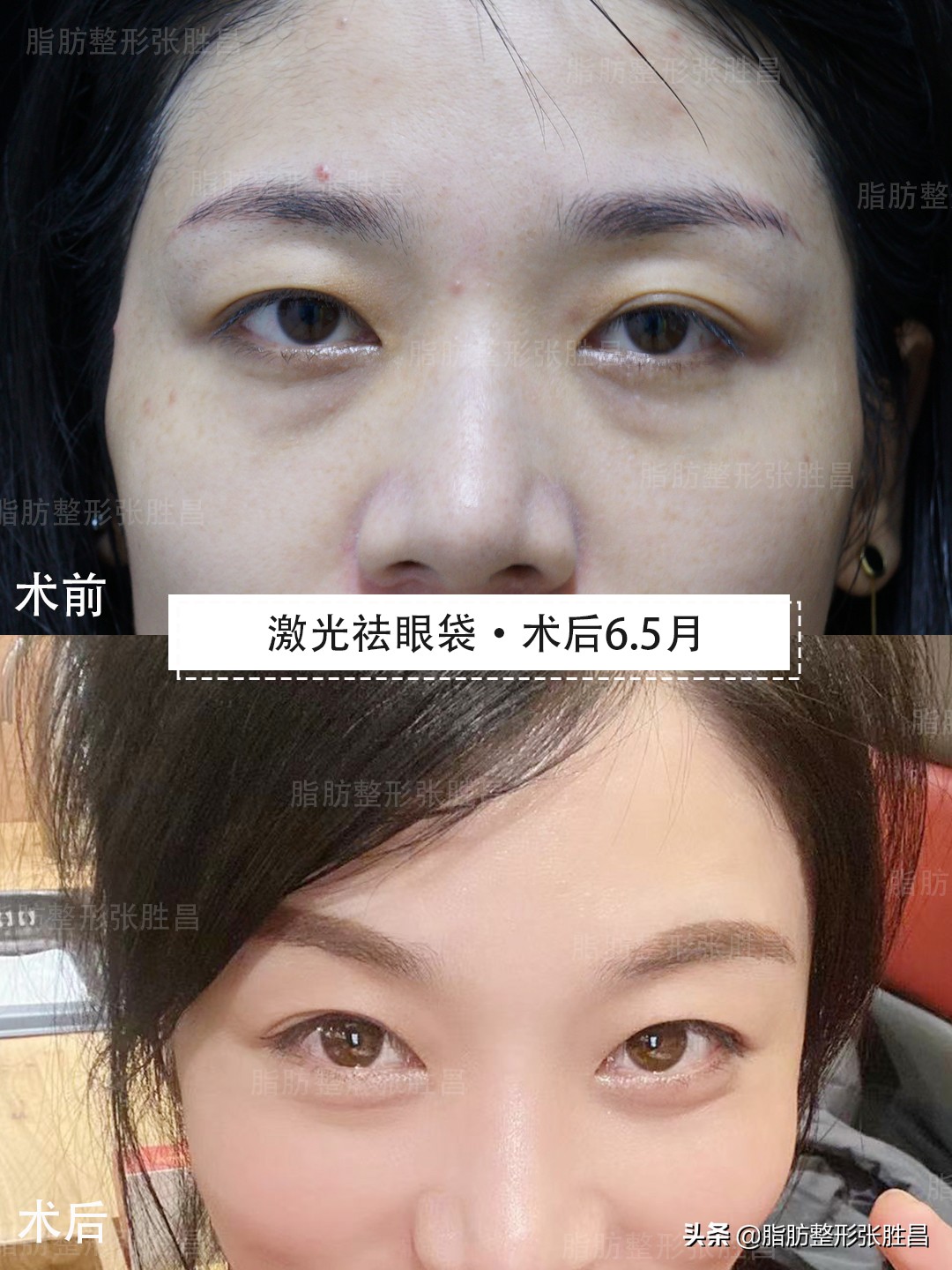 外切祛眼袋会去掉卧蚕吗,去眼袋会把卧蚕去掉吗